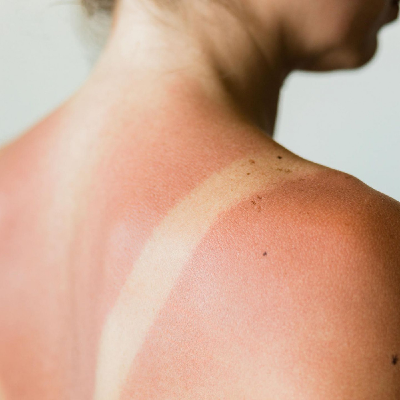 Quark soll gegen Sonnenbrand helfen – stimmt das?