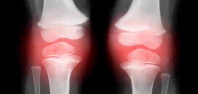 „Der Effekt von Gewichtsverlust bei Arthrose ist riesig“