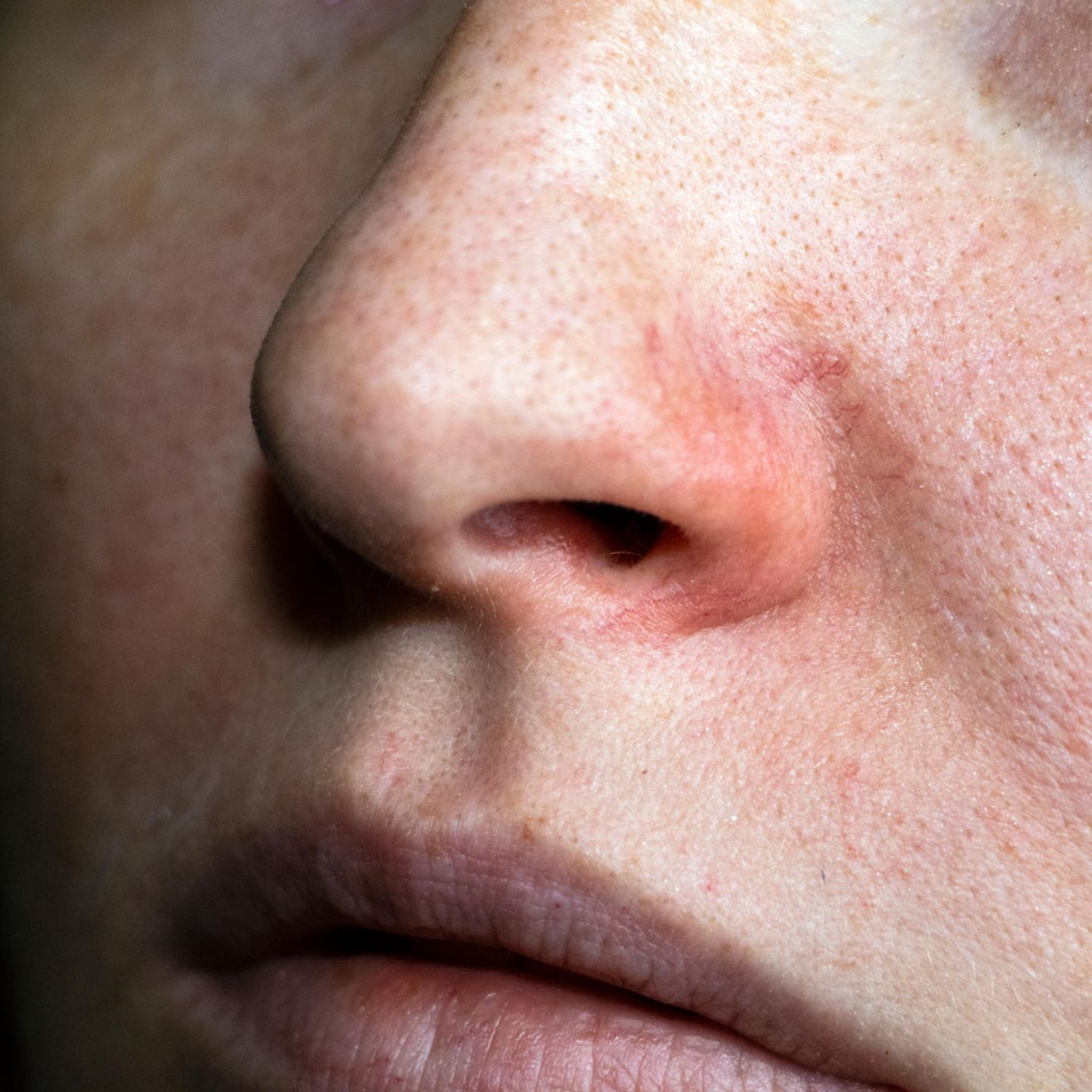 Rosacea-Creme gegen Hautrötungen: Diese Produkte sollen die Symptome lindern