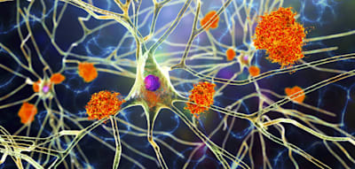 Warum es jetzt Hoffnung für Alzheimer-Patienten gibt