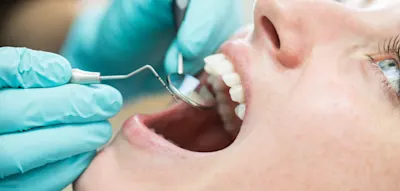 Forscher entwickeln Gel, das Zähne vor Löchern und Karies schützt