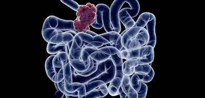 „Das Tückische ist: Viele laufen jahrelang mit Darmkrebs herum“