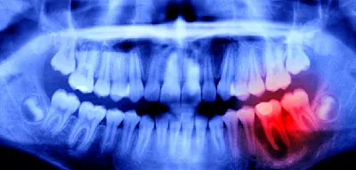 Wie gut eine Wurzelbehandlung der allgemeinen Gesundheit tut