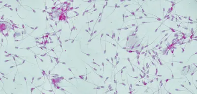 Samenspender mit Krebs-begünstigender Genmutation zeugte fast 200 Kinder