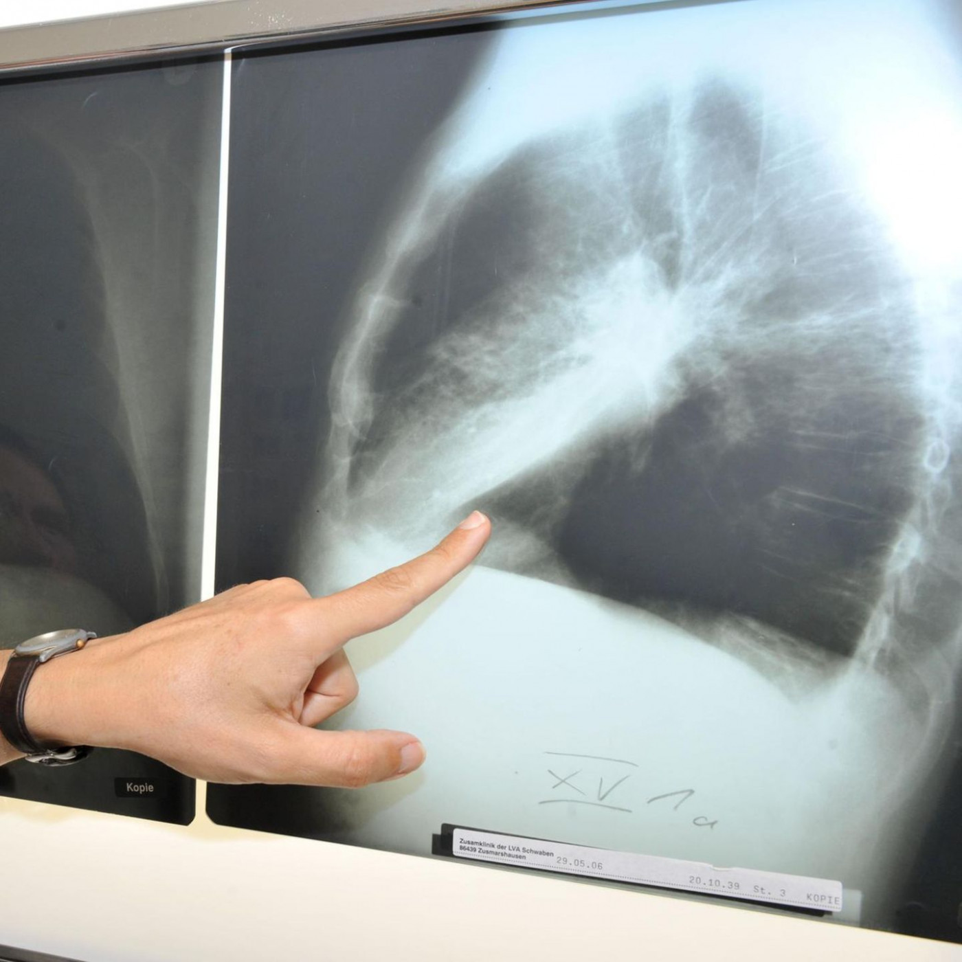 Sterberaten bei Lungenkrebs gehen in der EU zur&uuml;ck