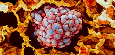 Die bemerkenswerte Entwicklung der Sterberaten bei Lungenkrebs &ndash; und ihre Ursachen