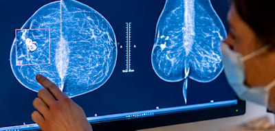 Diese Krebsarten treffen Deutschland am h&auml;ufigsten