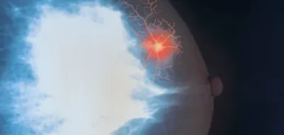 Simpler Bluttest soll wirksamste Therapie gegen Brustkrebs voraussagen