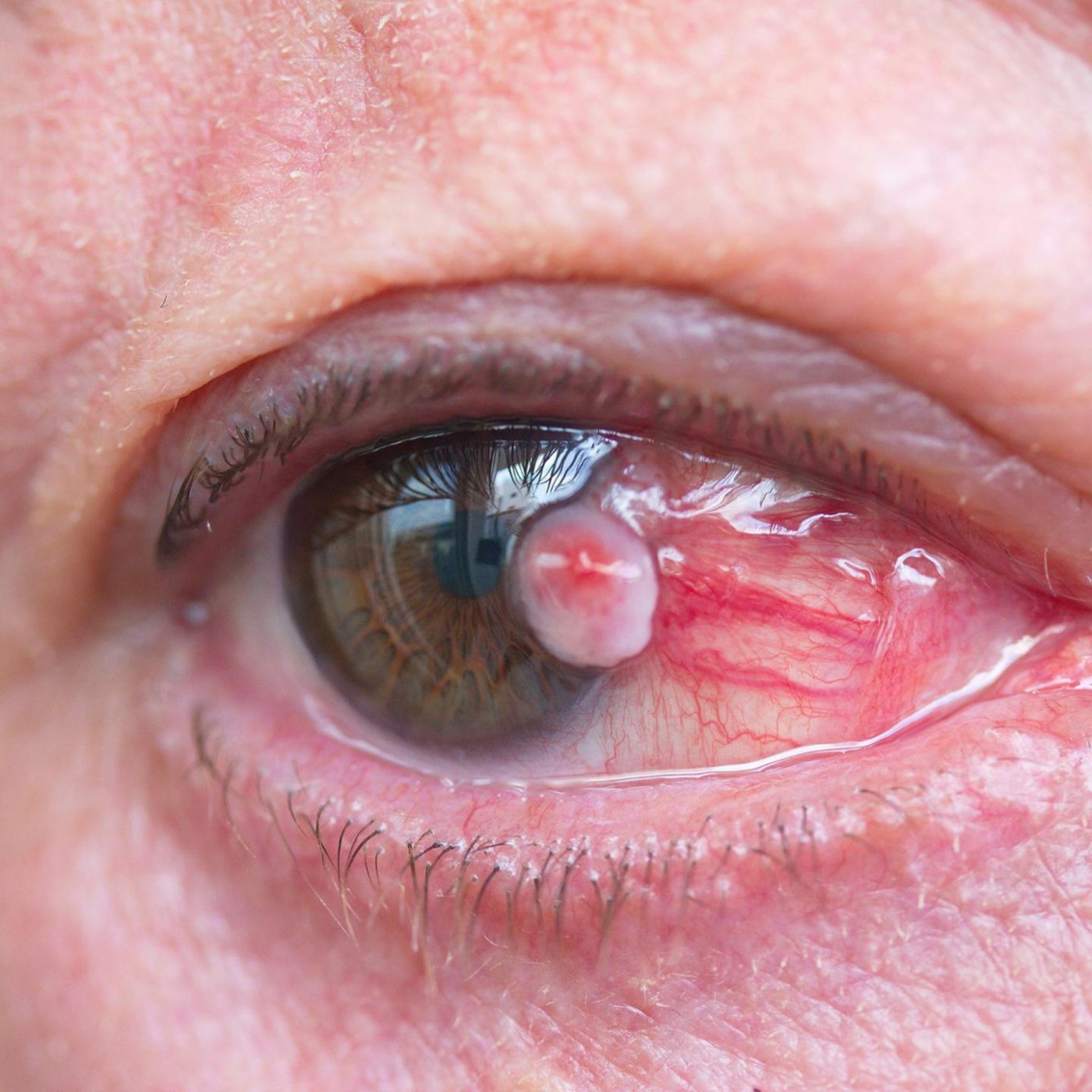 Diese Krebserkrankungen sind selten und werden oft zuf&auml;llig entdeckt