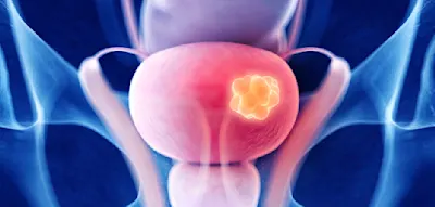 Wie Farbenblindheit die &Uuml;berlebenschance bei Blasenkrebs beeinflusst