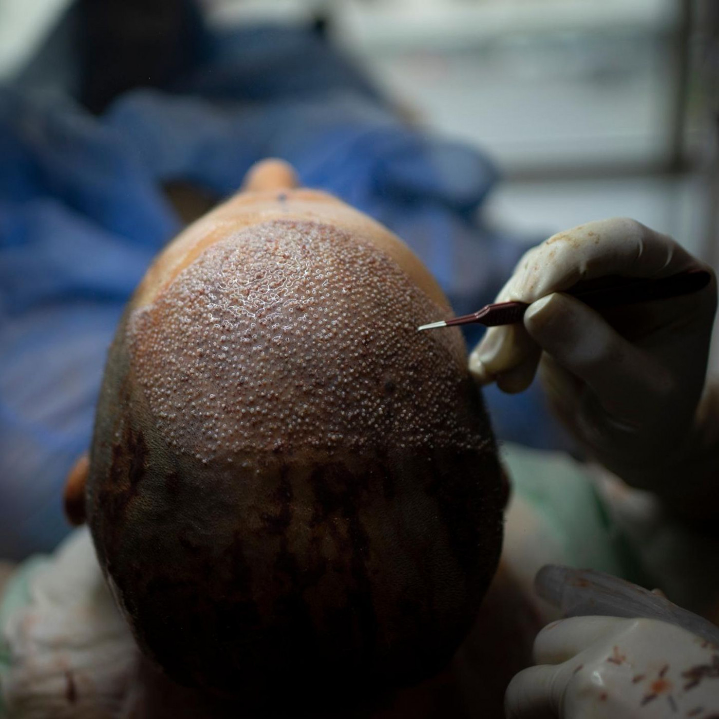 Sie w&uuml;nschen sich wieder mehr Haare? Das sollten Sie vorab wissen