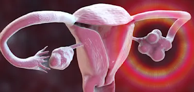 &bdquo;PCOS betrifft etwa eine von acht Frauen&ldquo;