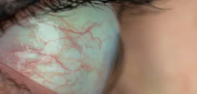 Was die Augen bereits Jahre im Voraus &uuml;ber die Herzgesundheit verraten